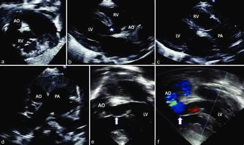 Echocardiogram A Subcostal Short Axis View And B Parasternal Long