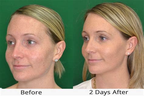 Nano Laser Skin And Facial Peel Treatments In Northern Va