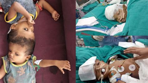 After 50 Hours Of Surgery Conjoined Twins Joined At Skull