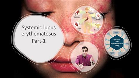 Systemic Lupus Erythematosus Part 1 Introduction Pathogenesis