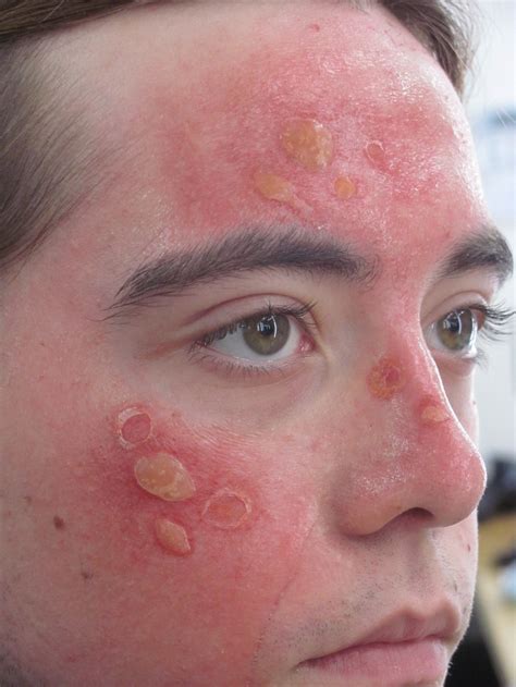 Sunburns On Face Pictures 8 Photos And Images