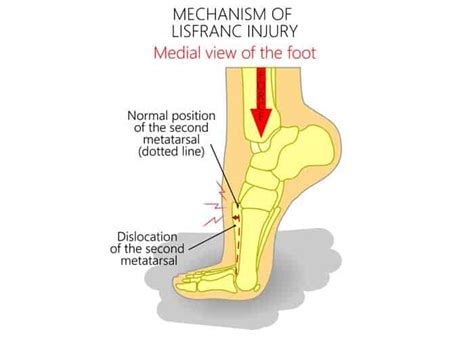 Symptoms of a lisfranc injury may include swelling of the foot, pain throughout the midfoot upon standing or during examination, inability to bear weight, bruising on the bottom of the foot in the arch area and. Lisfranc Injury | Lisfranc Treatment | Vail, Grand ...