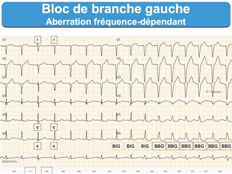 Bloc de branche 3. gauche incomplet : e-cardiogram