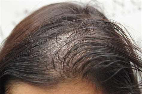 Doenças do couro cabeludo principais e seus tratamentos