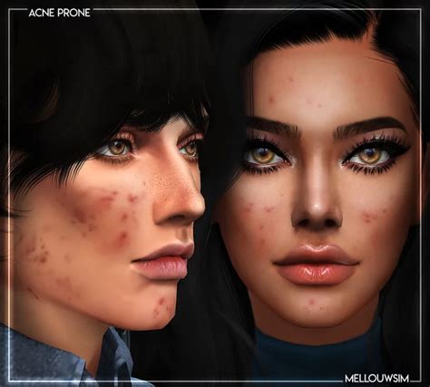 Los Mejores Detalles De Sims 4 Acne Skin Cc Todos Gratis Que Gamer