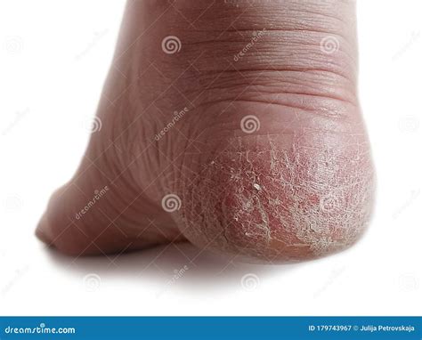 Onychomycosis And Dry Skin On The Heel Of The Female Leg Candida
