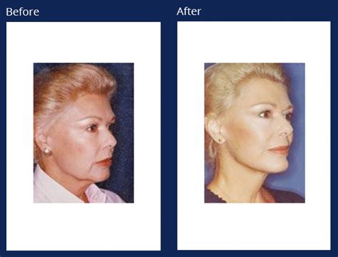 Facelift Holzapfel Lied Plastic Surgery