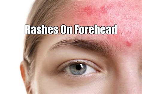 Rash On Forehead Causes And Treatments For Forehead Rashes In 2022