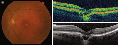 The Expanded Spectrum Of Focal Choroidal Excavation Jama