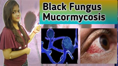 Black Fungus Mucormycosis Zygomycosis Mucormycetes Covid19