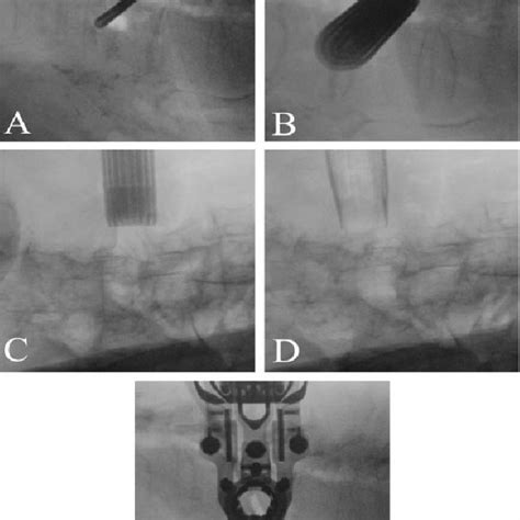 Pdf Minimally Invasive Direct Lateral Approach To The Thoracolumbar