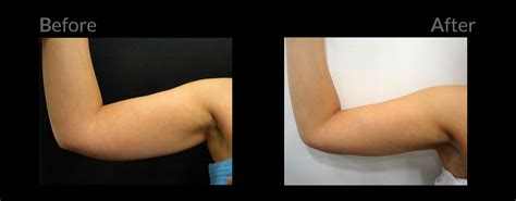 Laser Liposuction And Skin Tightening Before And After