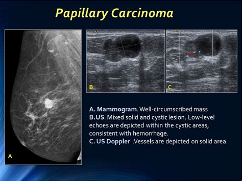 Figure 3 From Well Circumscribed Breast Carcinoma Keys To Face The