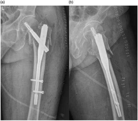 Intramedullary Nail For Intertrochanteric Hip Fracture Bios Pics