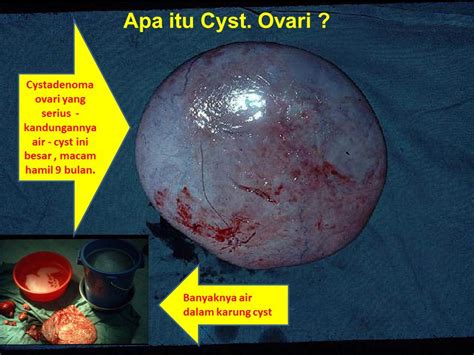 Massa ini sering ditemukan selama pemeriksaan panggul teratur. Apa itu Cyst ovari ? | Wannura Terapi