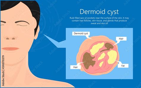Dermoid Cysts Symptoms On Patient Face Stock Vector Adobe Stock