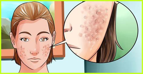 26 Simple Ways To Get Rid Of Acne Scars Naturally
