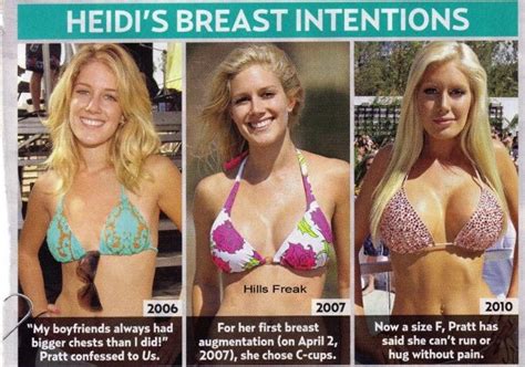 Breast Augmentation Before And After Heidi Montag Breast Implants Before And After