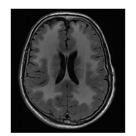 Figure E Mri Brain Of Proband Axial Flair Image From Mri Brain Of