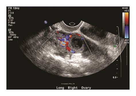Tvus Image Of Right Adnexa With Corpus Luteal Cyst Versus Ectopic
