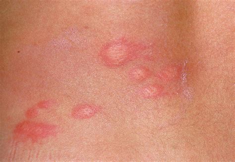 Urticaria Skin Rash Of The Back Of A Patient Photograph By