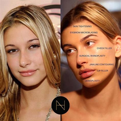 Hailey Baldwin Plastic Surgery