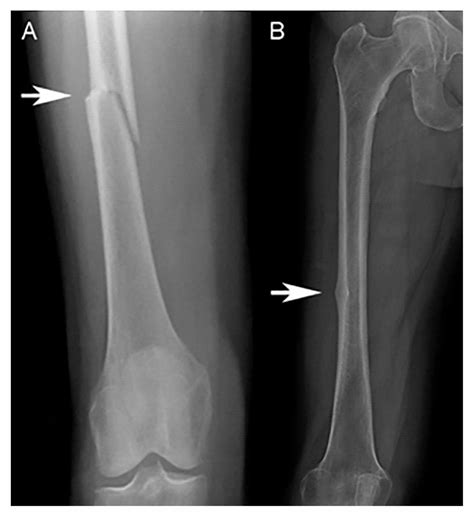 Atypical Femoral Fracture Cmaj