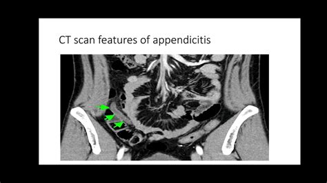 Acute Appendicitis Youtube