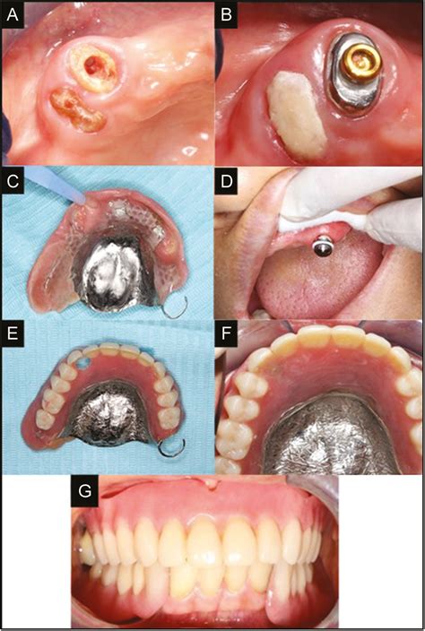 An Alternative Technique For Fabrication Of A Tooth Supported Removable