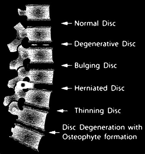 A thoracic herniated disc can cause upper back pain and other symptoms, such as radiating pain or numbness. Symptoms of a Herniated Disc PhysioChiroWellness Integrated