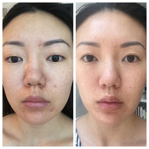 Face Treatment Before And After Doctor Heck