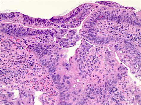 Pathology Outlines Adenocarcinoma Of The Esophagus And GE Junction