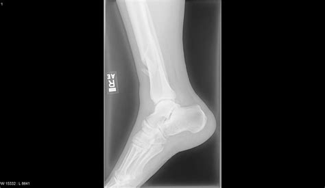 Fracture Of The Tibia Radrounds Radiology Network