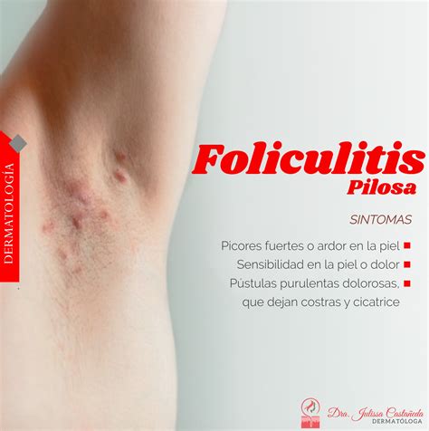 🌟la Foliculitis Es Una Afección Cutánea Frecuente En La Que Los