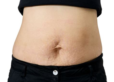 How To Get Rid Of Stretch Marks The Causes Best Products And How To Hide Or Reduce Irish