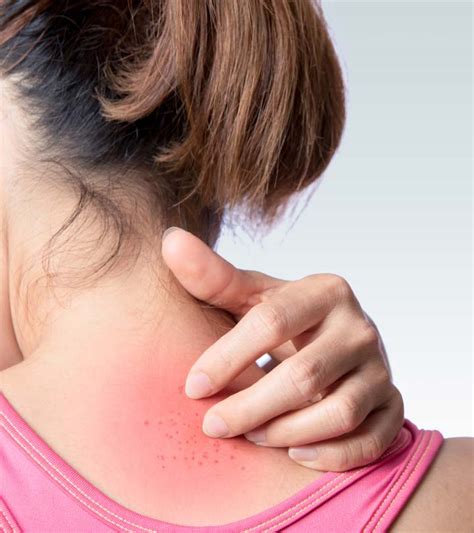 Hiv Skin Rashes Symptoms Causes And Treatment Options