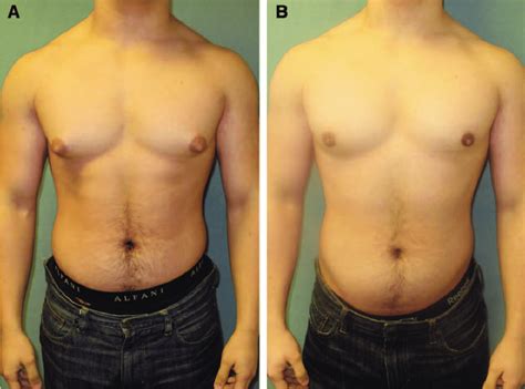 Gyno Surgery Nipples Male Telegraph