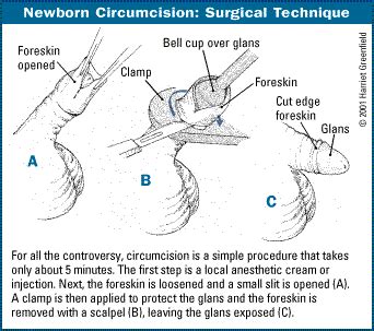Newborn Circumcision Technique Diary Of A Fit Mommy Sia Cooper