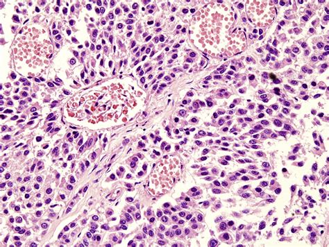 Disseminated Cryptococcosis In A Patient With Adrenocortical Carcinoma