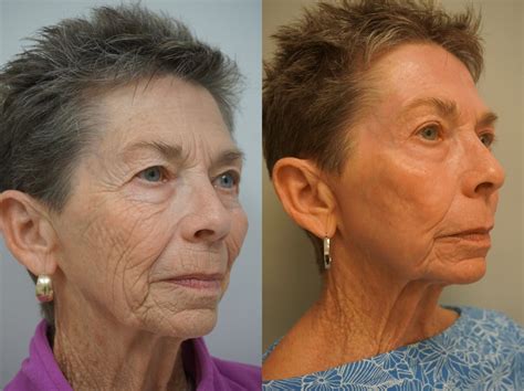 Renuvion J Plasma Skin Tightening Before And After Pictures Case 159