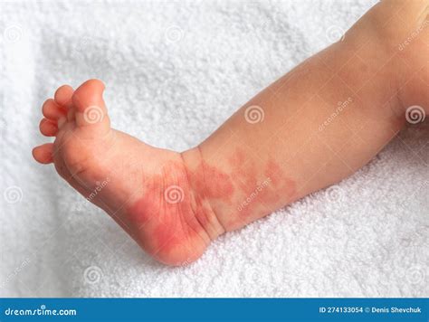 Hemangioma Red Birthmark On The Leg Of Newborn Baby Stock Photo Image