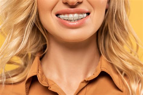 Can You Get Braces With Crowns Or Veneers
