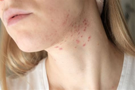 How To Identify And Treat Fungal Acne Health Wellness Blog