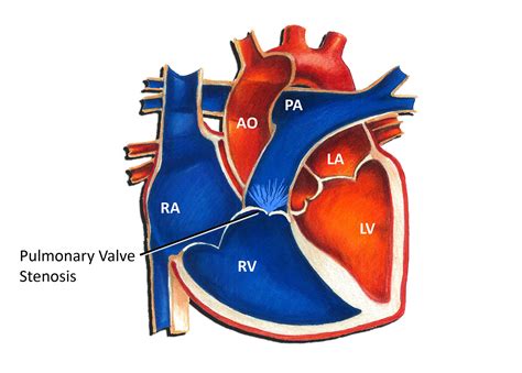 Pulmonary Valve Stenosis Pediatric Heart Specialists