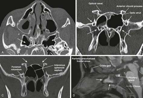 In their first year, residents should be well versed with normal radiographs, ultrasound and ct anatomy followed by mri in the consequent years. Nose and Sinonasal Cavities | Radiology Key