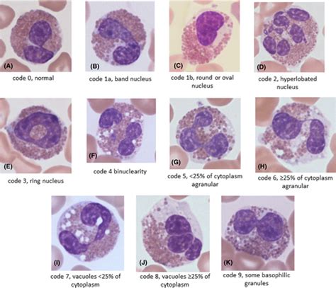 The Role Of Eosinophil Morphology In Distinguishing Between Reactive