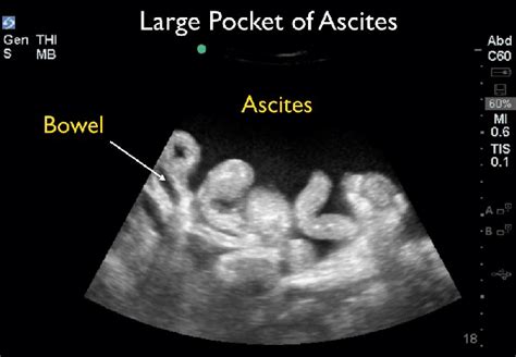 Ultrasound Large Pocket Of Ascites Download Scientific Diagram