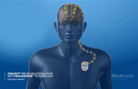 Innovative Deep Brain Stimulation Device Reads Brain Signals Allowing For Individualized