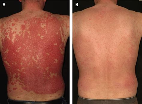 Newer Agents For Psoriasis In Adults The Bmj