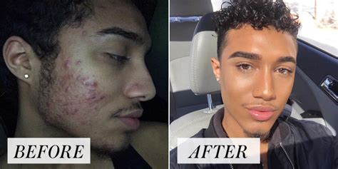 Bad Acne Before And After Makeup Saubhaya Makeup